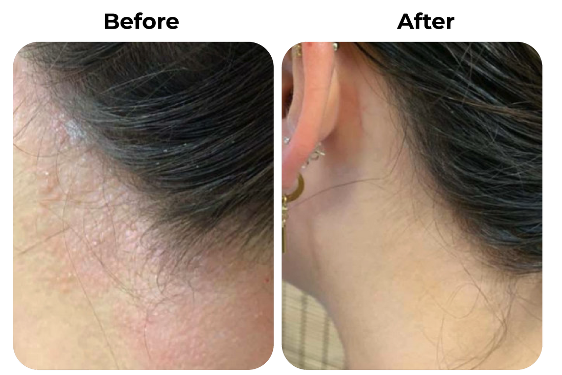 Before and after eczeem en psoriasis langs haarlijn en nek behandeld met natuurlijke psoriasis en eczeem zalf van Hair and Nature