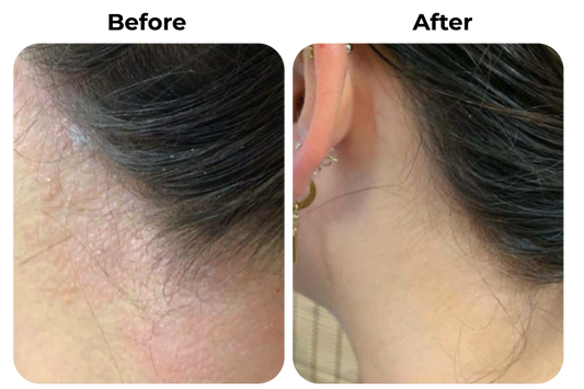 Before and after eczeem en psoriasis langs haarlijn en nek behandeld met natuurlijke psoriasis en eczeem zalf van Hair and Nature