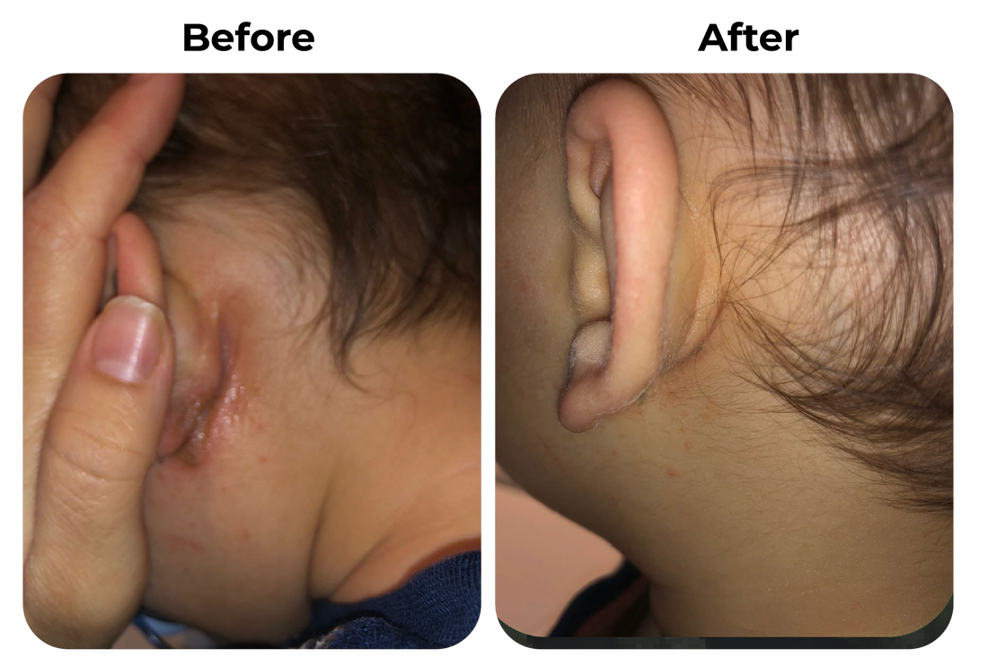 eczeem oor kind before en after