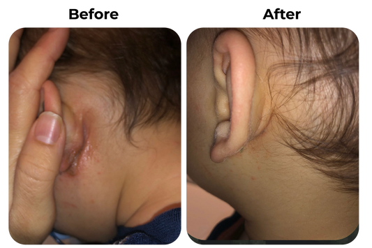 eczeem oor kind before en after