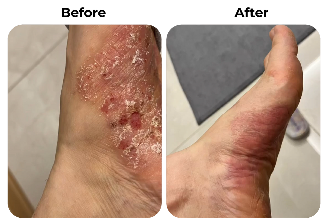 Before and after psoriasis op voet verminderen met natuurlijke psoriasis en eczeem zalf van Hair and Nature