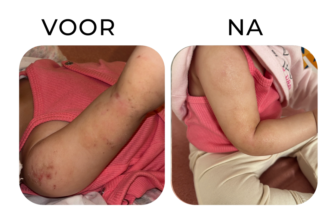 Before and after droge en geïrriteerde huid bij 3-jarig kindje zichtbaar verbeterd na gebruik van natuurlijke eczeem zalf