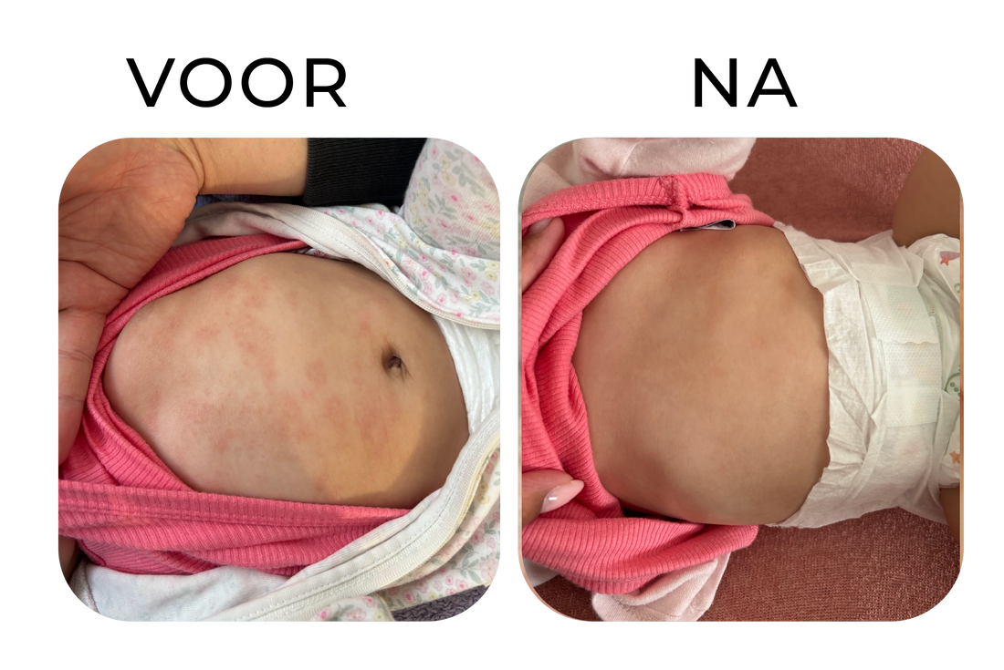 Rode plekjes op de buik bij een kind verminderen – before & after van Elissa