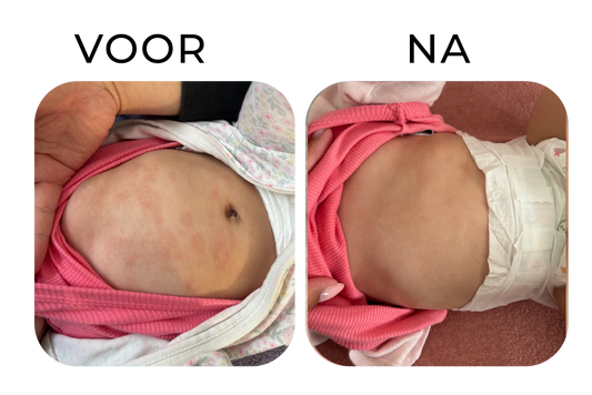 Rode plekjes op de buik bij een kind verminderen – before & after van Elissa