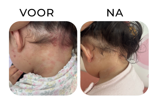 Gevoelige huid in de nek en haarlijn verminderen – before & after resultaat