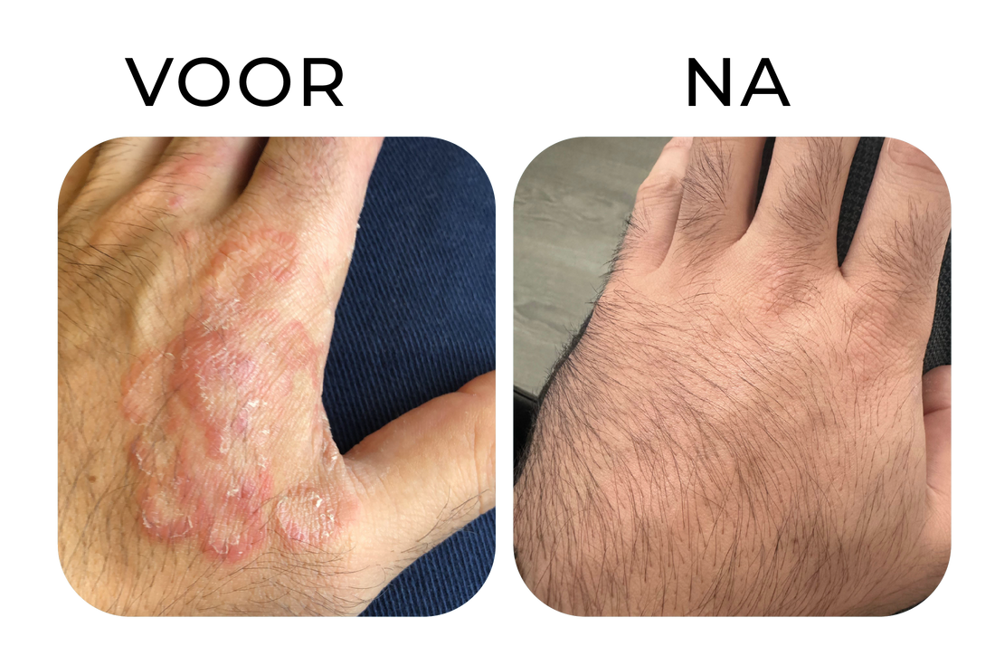 Droge handhuid en irritatie verminderen – before & after resultaat