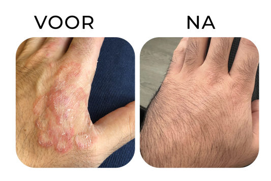 Droge handhuid en irritatie verminderen – before & after resultaat
