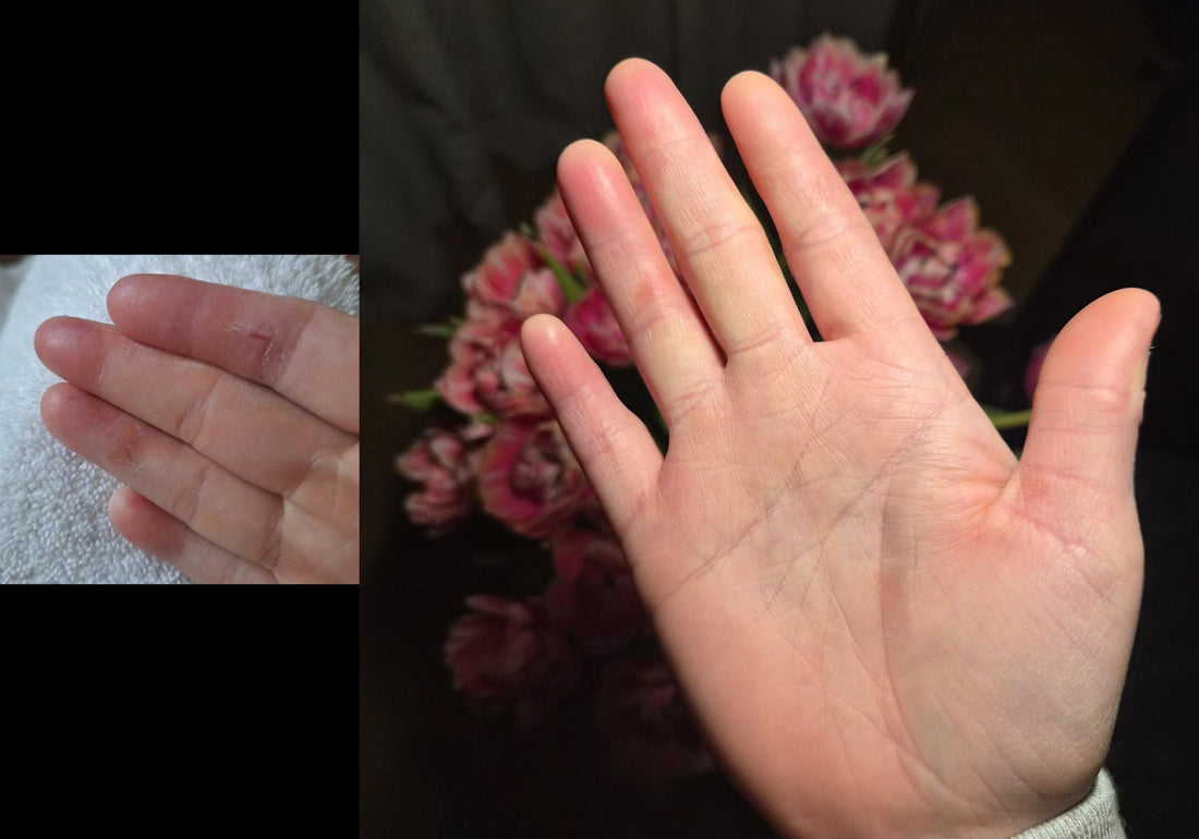 eczeem handen before after huid herstel droge huid verminderd