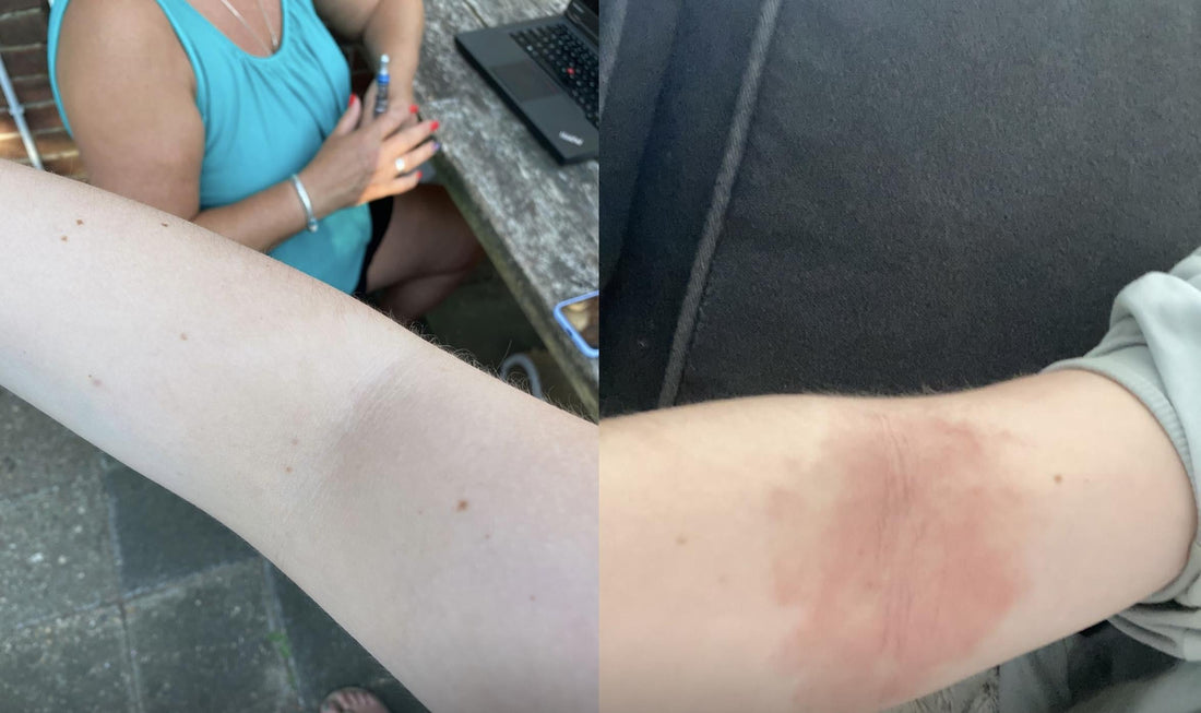 eczeem before after kind huid verbetering