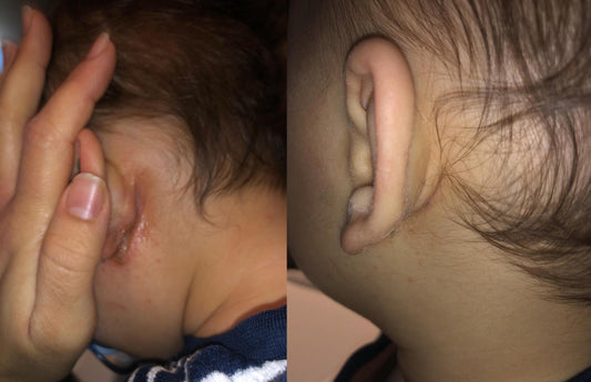 eczeem kind oor before after huid herstel roodheid verminderd