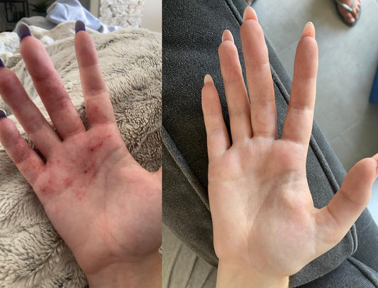 eczeem handen before after natuurlijk herstel zonder hormoonzalf