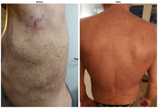 Zichtbaar herstel na dialyse-gerelateerde huidproblemen