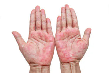 psoriasis handen rode plekken schilfering eczeem symptomen handpalmen