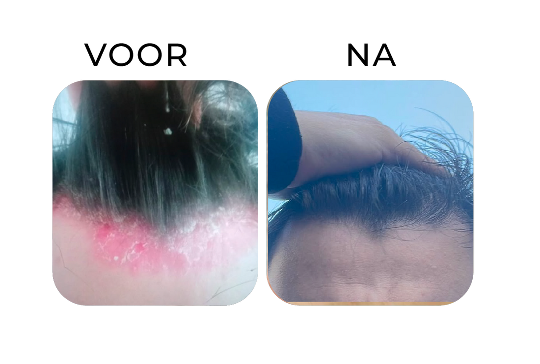 Before en after van psoriasis op de hoofdhuid – links een rode, schilferige haarlijn met psoriasis, rechts een zichtbaar rustige hoofdhuid waarbij de roodheid en schilfers sterk zijn vermind
