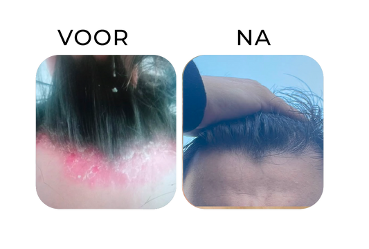 Before en after van psoriasis op de hoofdhuid – links een rode, schilferige haarlijn met psoriasis, rechts een zichtbaar rustige hoofdhuid waarbij de roodheid en schilfers sterk zijn vermind