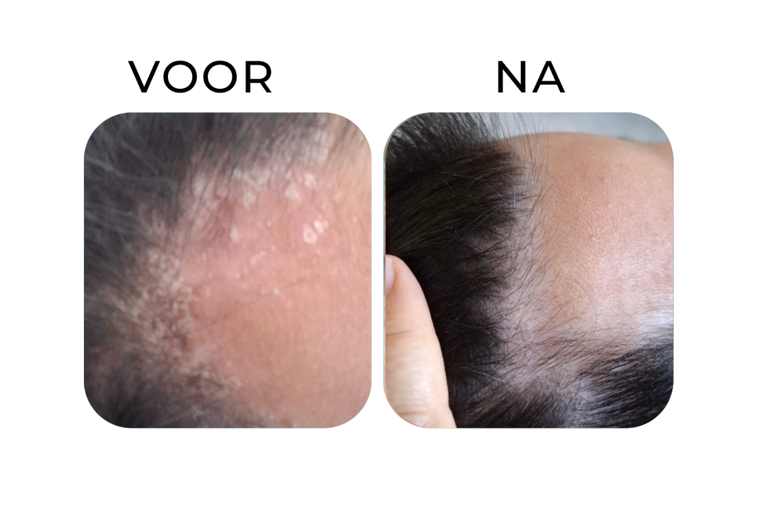 Before en after van psoriasis op het onderbeen. Links een onderbeen met meerdere felrode, schilferende psoriasisplekken, rechts een zichtbaar rustige huid waarbij de roodheid en schilfering sterk zijn verminderd.