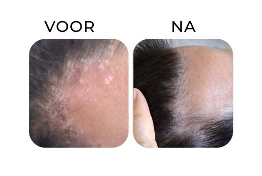 Before en after van psoriasis op het onderbeen. Links een onderbeen met meerdere felrode, schilferende psoriasisplekken, rechts een zichtbaar rustige huid waarbij de roodheid en schilfering sterk zijn verminderd.