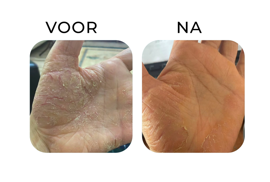 Before en after van handeczeem – links een hand met droge huid, diepe kloven en schilfering, rechts een zichtbaar rustigere hand met minder schilfers en een beter gehydrateerde huid.