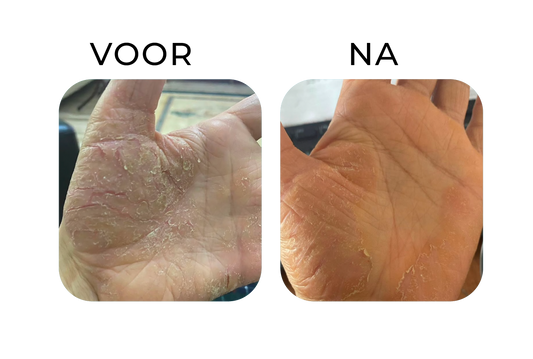 Before en after van handeczeem – links een hand met droge huid, diepe kloven en schilfering, rechts een zichtbaar rustigere hand met minder schilfers en een beter gehydrateerde huid.
