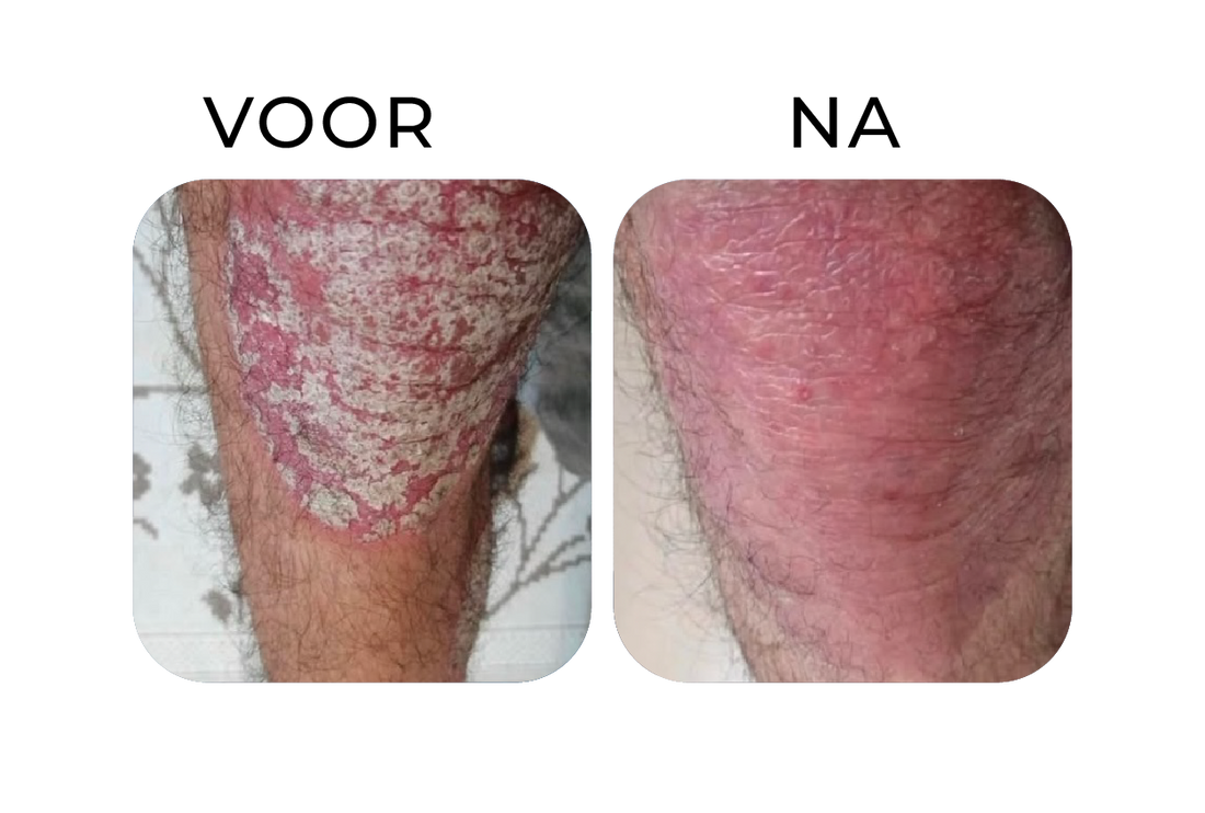 Before en after van psoriasis op de knie – links een knie met dikke witte schilfers en ernstige roodheid, rechts een zichtbaar rustigere huid met sterk verminderde schilfering na consequente verzorging.