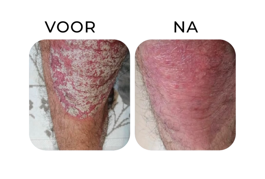 Before en after van psoriasis op de knie – links een knie met dikke witte schilfers en ernstige roodheid, rechts een zichtbaar rustigere huid met sterk verminderde schilfering na consequente verzorging.