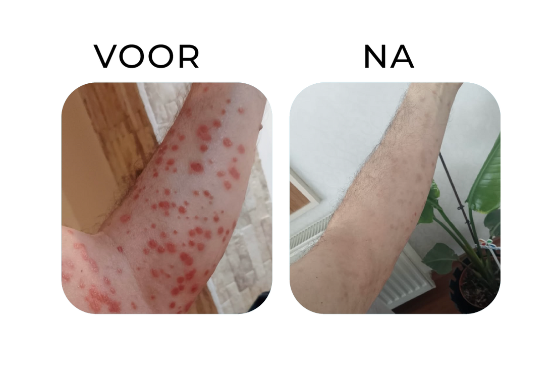 Before en after van psoriasis op de onderarm – links een arm met veel rode psoriasisplekken, rechts een zichtbaar rustigere huid waarbij de roodheid vrijwel verdwenen is na consequente verzorging.