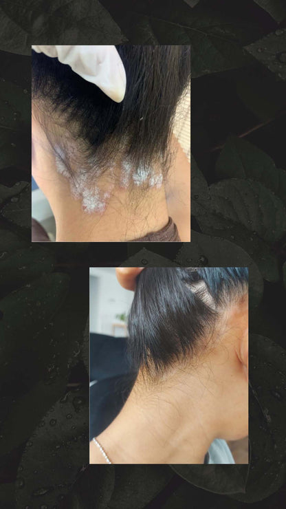RESULTAAT NATUURLIJK ZALFJE PSORIAS EN ECZEEM - HAIR AND NATURE