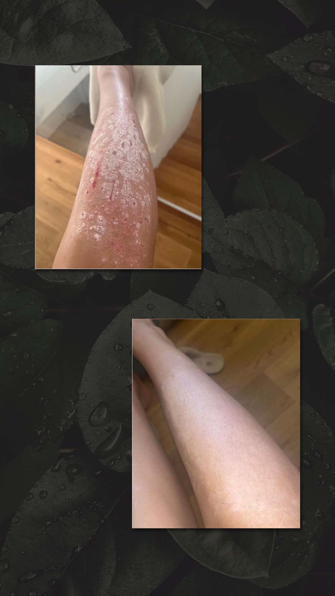 RESULTAAT NATUURLIJK ZALFJE PSORIAS EN ECZEEM - HAIR AND NATURE