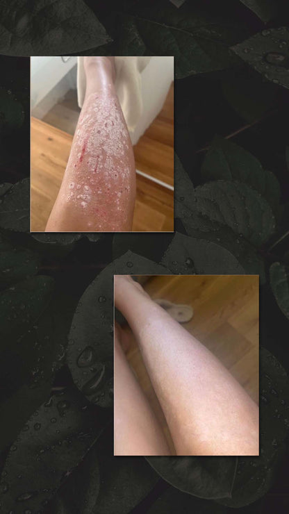 RESULTAAT NATUURLIJK ZALFJE PSORIAS EN ECZEEM - HAIR AND NATURE