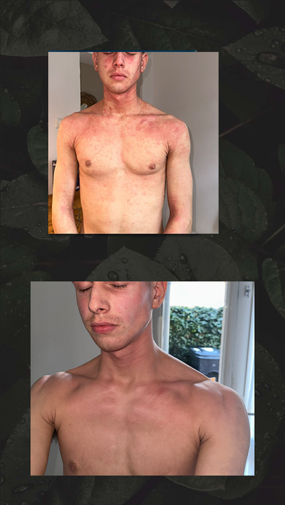 HAIR AND NATURE PSORIASIS &amp; ECZEMA TRIAL OINTMENT 10GRAM