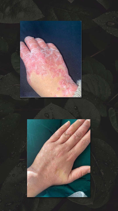 HAIR AND NATURE PSORIASIS &amp; ECZEMA TRIAL OINTMENT 10GRAM