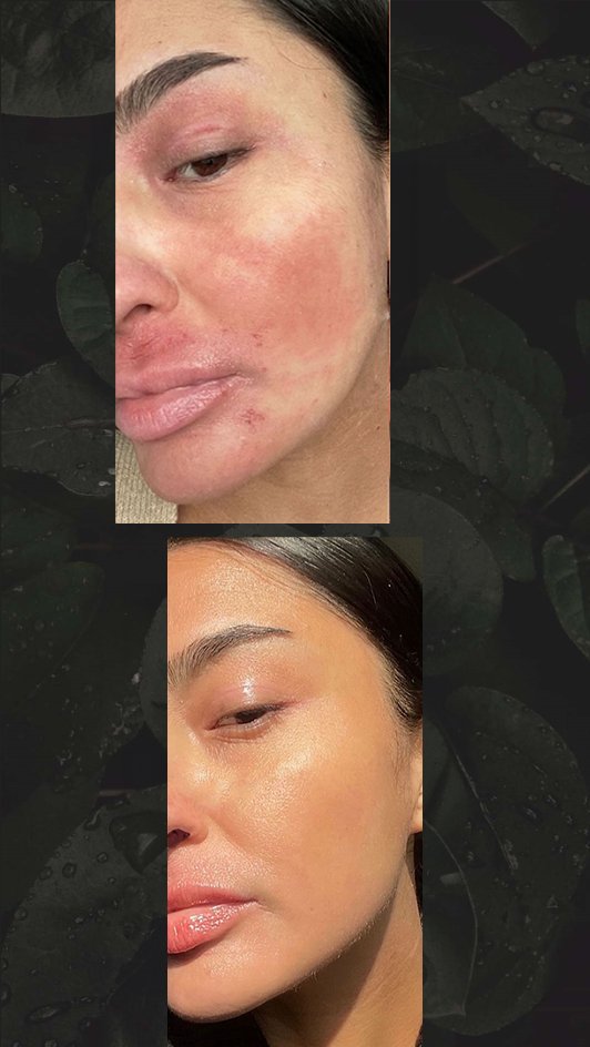 HAIR AND NATURE PSORIASIS &amp; ECZEMA TRIAL OINTMENT 10GRAM