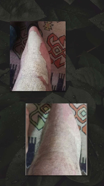 HAIR AND NATURE PSORIASIS &amp; ECZEMA TRIAL OINTMENT 10GRAM