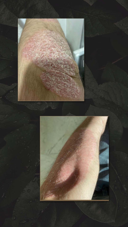 HAIR AND NATURE PSORIASIS &amp; ECZEMA TRIAL OINTMENT 10GRAM